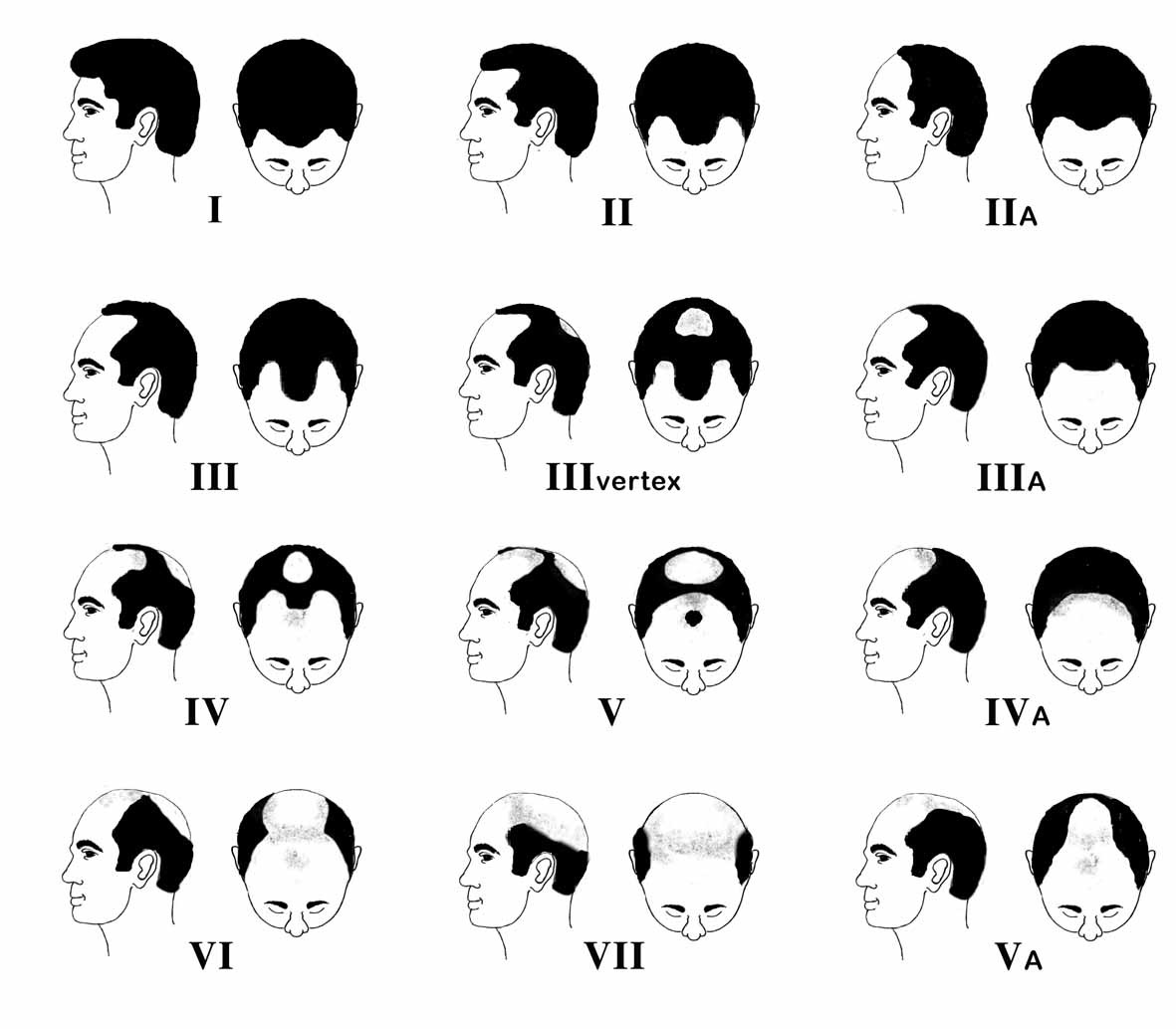 Poster Dermatologico - Scala Densità Perdita Capelli Maschile Savin - Strumento Medico - Foto 3
