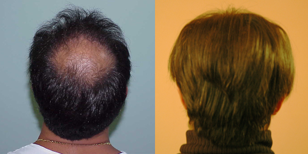 Riavere i capelli con la Fue